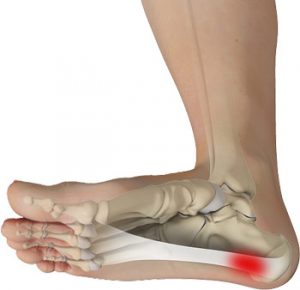 plantar-fasciitis