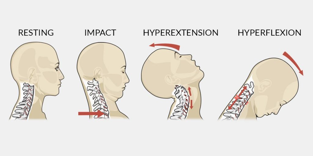 Whiplash Associated Disorder (w. A.D.) Archives - Physiotherapists in