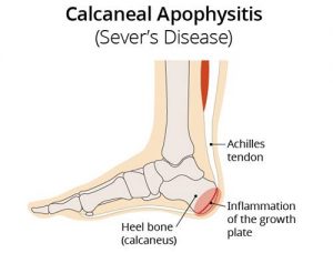 inflammation of growth plate in foot