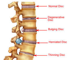 Back pain