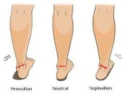 flat foot underpronation