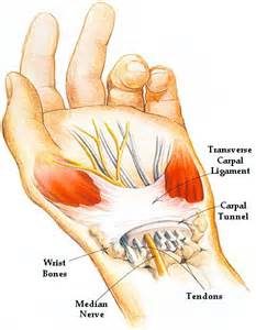 Carpal tunnel syndrome