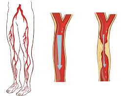Arterial Endofibrosis