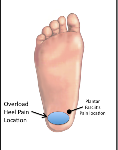 Fat Pad Syndrome or Plantar fasciitis 