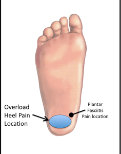 fat pad contusion heel treatment