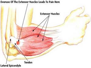 Tennis Elbow Misdiagnosis