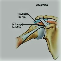 sub-acromial bursitis 