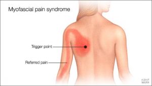 myofascial-pain-syndrome