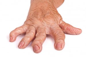 rheumatoid arthritis