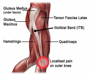 iliotibial band syndrome