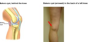 knee injuries