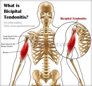 Biceps Tendonitis Causes and Symptoms - Sinew Therapeutics