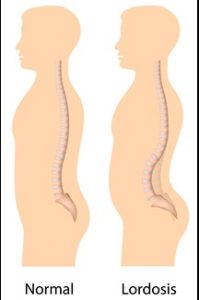 Lordosis