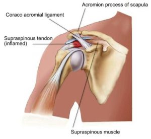 shoulder-Impingement