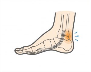 Posterior ankle impingement physiotherapy