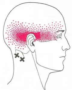 suboccipttal trigger points