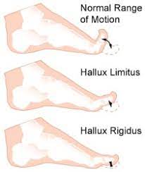 Hallux Rigidus