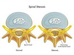 stenosis of spine