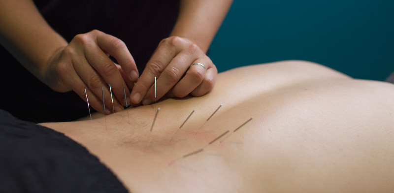 Dry-Needling