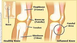 osgood schlatter