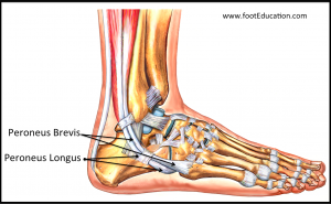 Peroneal tendonitis