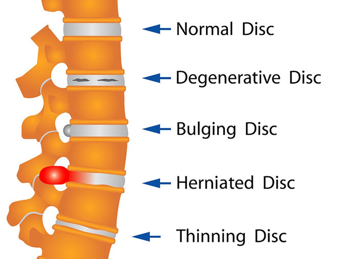 Herniated Disc vs Bulging Disc - Eddie O'Grady Physiotherapist
