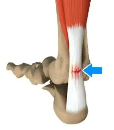 Achilles Tendon Rupture