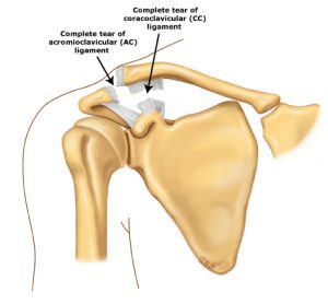 AC Joint Injuries