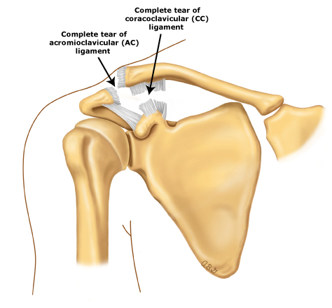 AC Joint Injuries