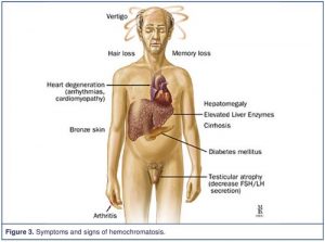 Haemochromatosis