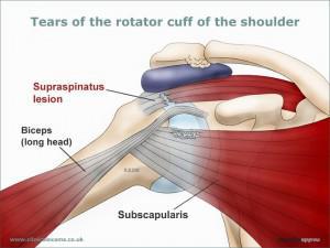 Supraspinatus tear