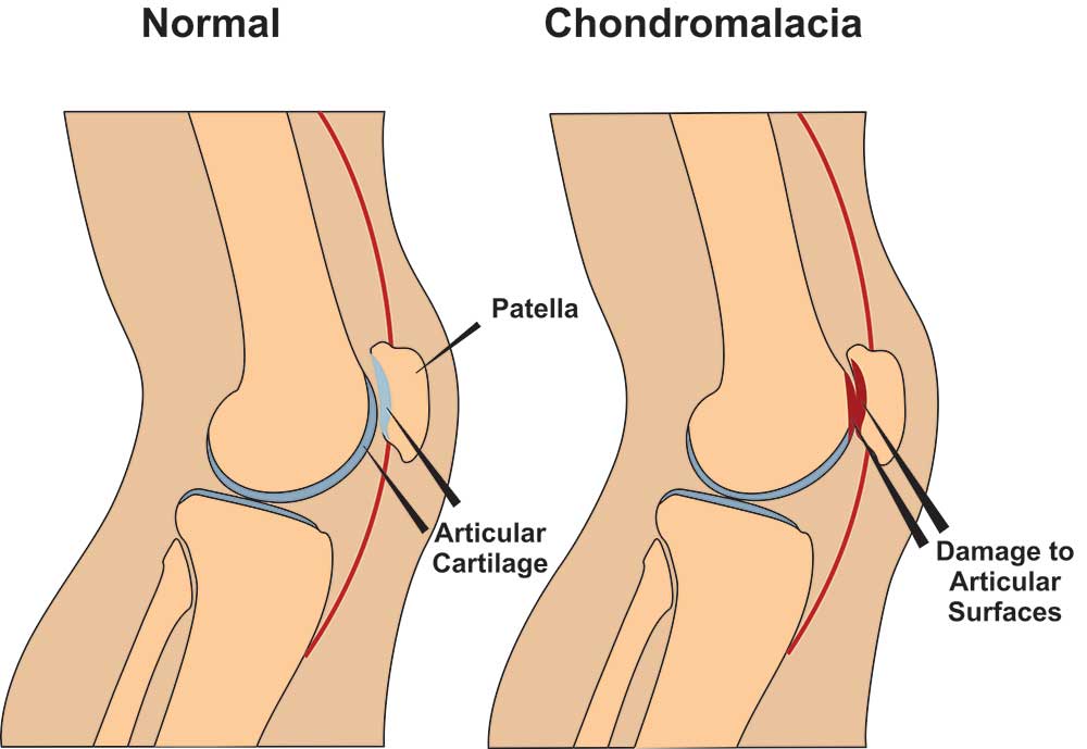 Chondromalacia patella